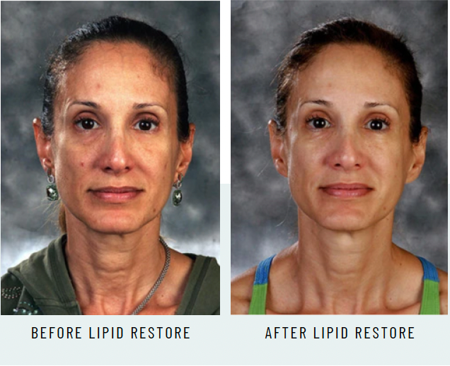 LIPID RESTORE