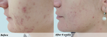 REDNESS RELIEF SERUM