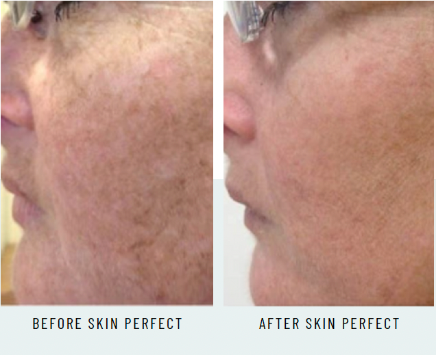 SKIN PERFECT